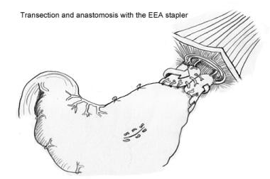 Modified Sugiura procedure. Transection and anasto