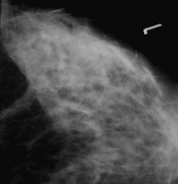 Mammogram Technique: Approach Considerations, Mammographic Examination ...