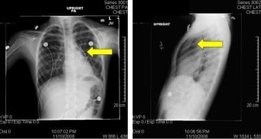 Chest radiographs in anteroposterior (AP) and late