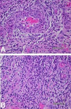 Histology of ulcers revealing neutrophilic infiltr