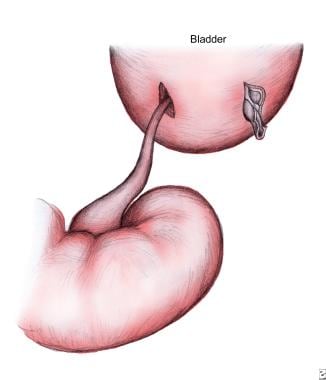 Anastomosis of kidney transplant ureter to bladder