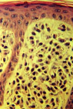 Hematoxylin and eosin stain revealing mast cells i