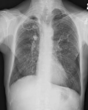Chest radiograph in a 67-year-old man who smokes a