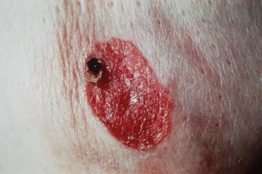 Nipple adenoma in a female patient presenting with persistent erythema of  the right nipple skin: case report, review of the literature, clinical  implications, and relevancy to health care providers who evaluate and