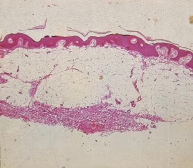 Photomicrograph shows the histopathologic findings