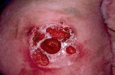 Pyderma Gangrenosum