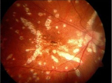 Late stages of multifocal choroiditis: Note the mu