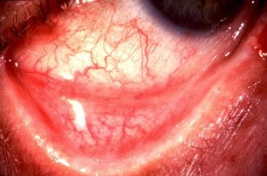 「epidemic keratoconjunctivitis」的圖片搜尋結果