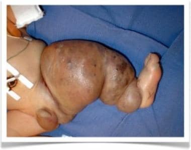 Clinical image of male newborn with Klippel-Trenau