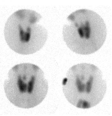 Thyroid nuclear scan of a patient with a euthyroid