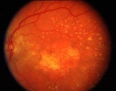 Color photograph of the fundus shows nonexudative 