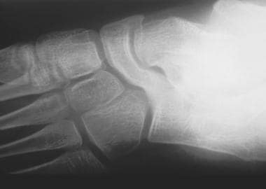 Ball and socket ankle joint  Radiology Reference Article