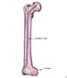 Intertrochanteric Hip Fractures