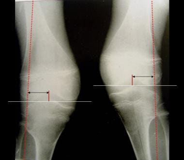 Right calcaneal fracture in a 36-year-old male patient treated with