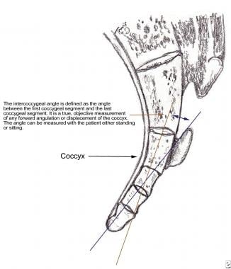 Coccygodynia