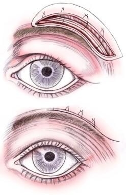 Direct brow lift. Fixation of brow and closure. 