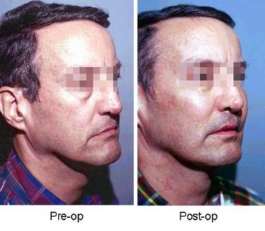 Side view of patient before and after insertion of