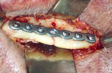 Mandibular fracture. Open reduction rigid internal