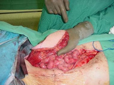Perineal reconstruction. This 70-year-old man with