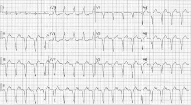 Ventricular Tachycardia Workup Approach Considerations Laboratory Studies Electrocardiography