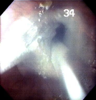 Cryoablation of esophageal lining in Barrett esoph