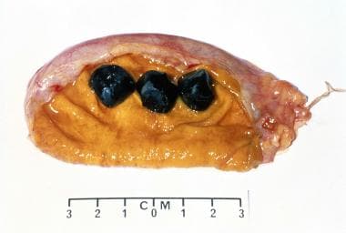 Excised gall bladder opened to show 3 gallstones. 