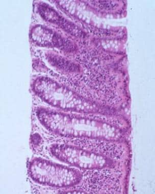 Microscopic Colitis (Collagenous and Lymphocytic C