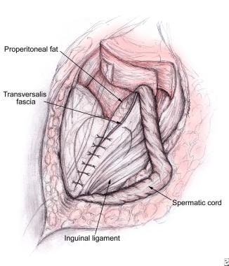 Figure 7 from Femoral Hernia: A Review of the Clinical Anatomy and Surgical  Treatment