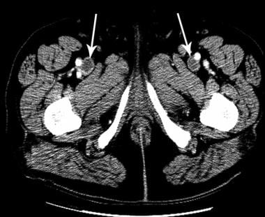 Deep Venous Thrombosis (DVT). The computed tomogra