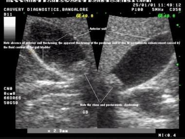 Gallbladder Mucocele: Practice Essentials, Background, Pathophysiology