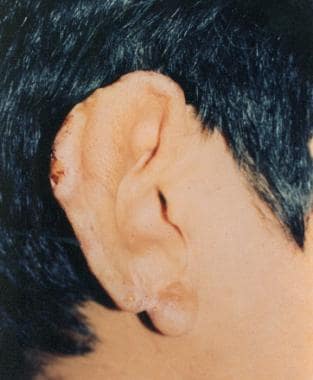 Cutaneous leishmaniasis lesions. Photo courtesy of