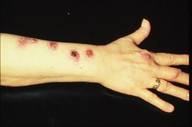 Mycobacterium marinum Infection Clinical Presentation: History