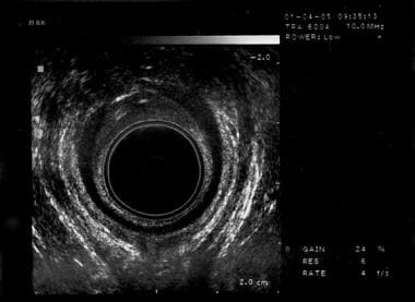 Fecal incontinence. Ultrasound taken with the pati