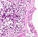 Small Cell Lung Cancer (SCLC)