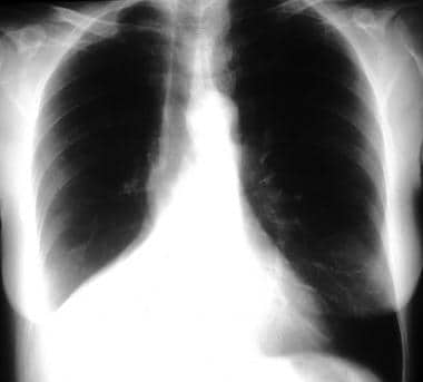 Atelectasis. Both right lower lobe and right middl
