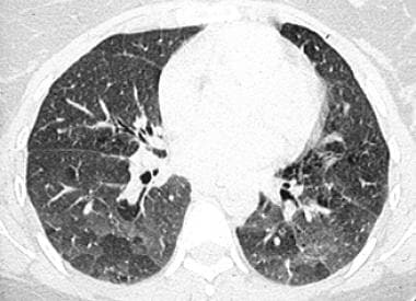 High-resolution CT scan of lungs shows ground-glas