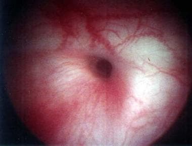 Cystoscopic view of vesicovaginal fistula. 