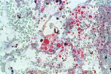 Frozen section of lung stained with oil red O show