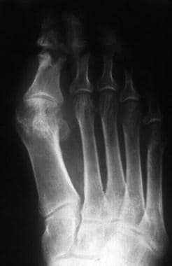 Osteomyelitis of the great toe. Photography by Dav
