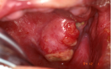 A nasal cavity tumor has eroded through the hard p