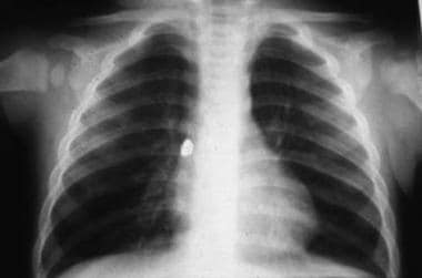 Ribcage of 4 day old patient. Measurements of the width of the