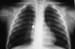 Foreign Bodies of the Airway