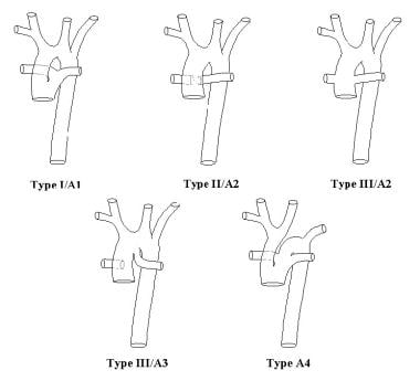 Anatomic subtypes of truncus arteriosus (TA), acco