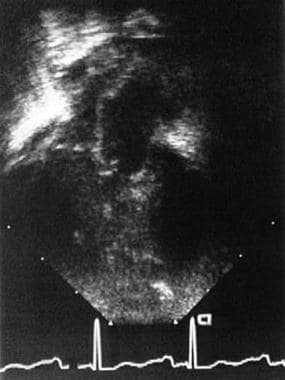 This two-dimensional echocardiogram (apical 4-cham