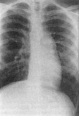 Surgical Approach to Corrected Transposition of th