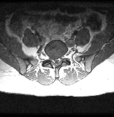 Magnetic Resonance Imaging (MRI): Lumbar Spine (for Parents)