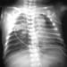 Congenital Pneumonia