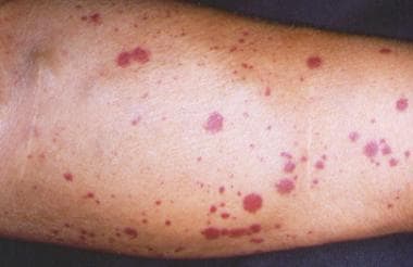 Purpuric papules and plaques of the lower extremit