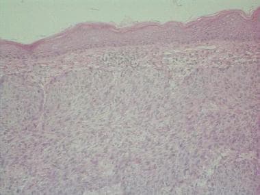 Metastatic squamous cell cancer typically does not