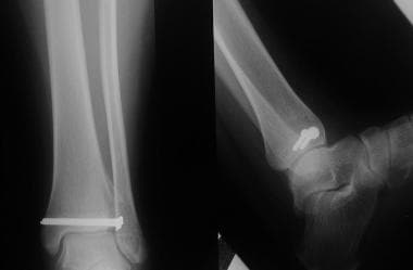 Growth plate (physeal) fractures. Healed Tillaux f